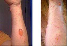 Type IV Hypersensitivity | Reactions & Examples - Lesson | Study.com