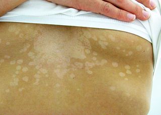 Skin Infection Color Skin Fungal Infections | Types, Causes & Symptoms - Lesson | Study.com