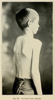 Pott's Disease | Symptoms, Diagnosis & Treatment - Lesson | Study.com