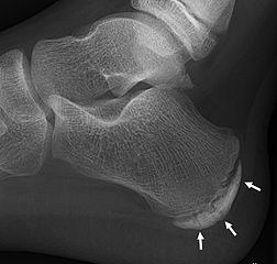 Calcaneal Apophysitis in Adults & Children | Study.com