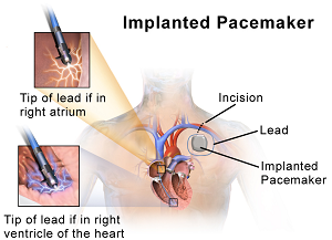 Living with AFib: Drugs & Pacemakers | Study.com