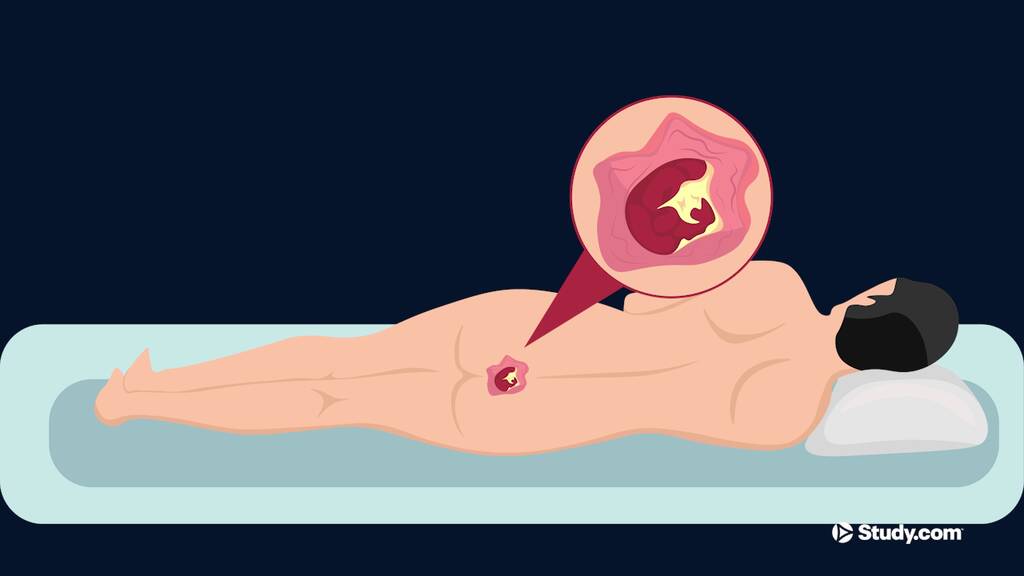 Sacral Decubitus Ulcer | Sacral Wound Stages & Treatments - Lesson ...