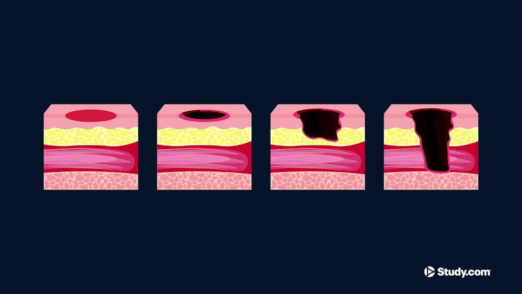 Undermining Wound | Definition, Causes & Treatment - Video | Study.com