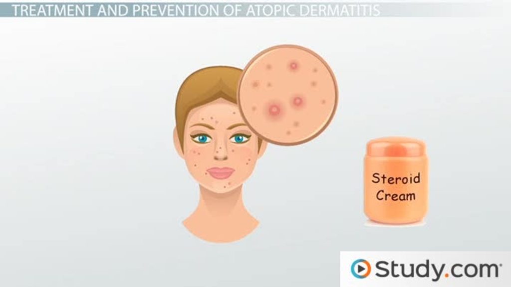 Atopic Dermatitis: Skin Allergies - Lesson | Study.com