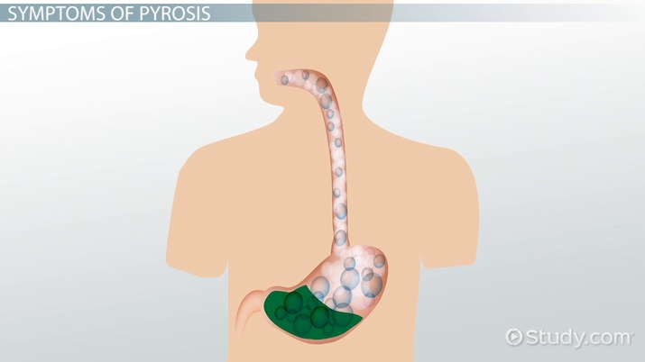 Pyrosis | Heartburn Definition, Causes & Treatment - Lesson | Study.com