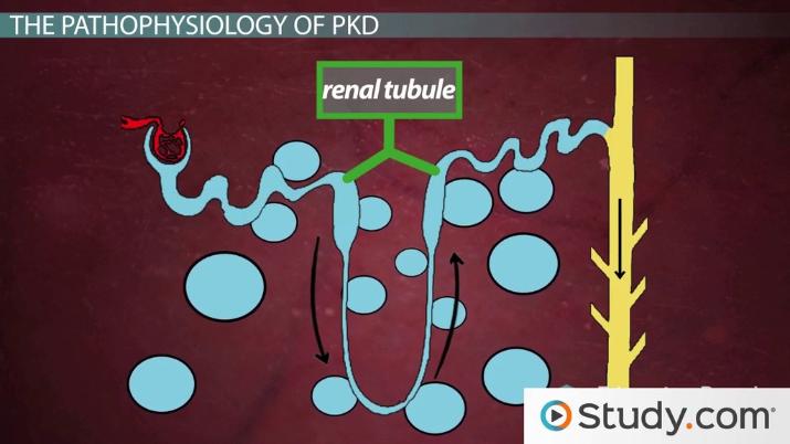 Polycystic Kidney Disease: Affected Locations, Signs & Treatments ...
